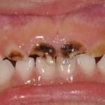 Do you know your sweet kisses could spread cavity-causing bacteria to your child?